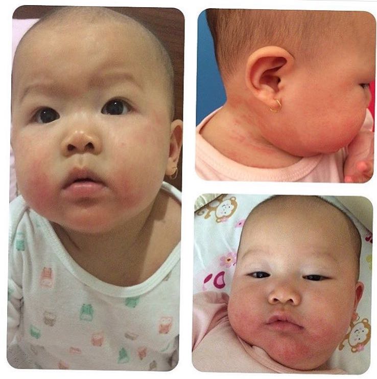 Food allergy in Baby, eczema is not that scary image